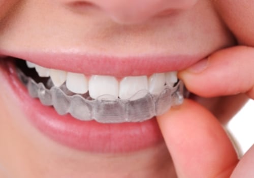 Straighten Your Teeth Discreetly With Invisalign Clear Braces In Commerce City
