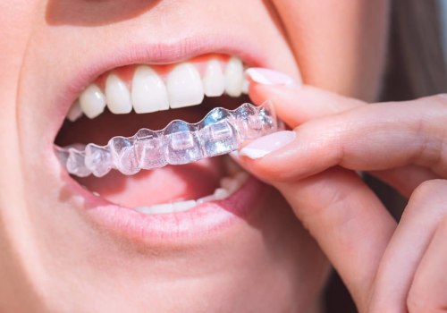 How Invisalign Clear Braces Can Transform Your Smile In Dripping Springs, TX