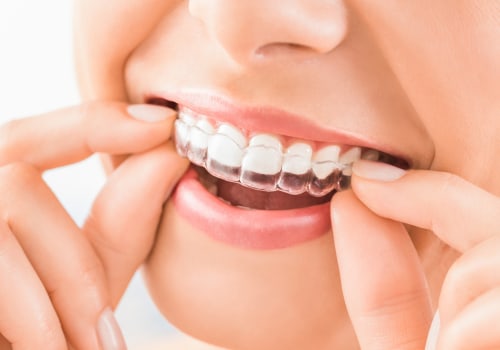 How Long Does it Take to Get Invisalign Clear Braces?