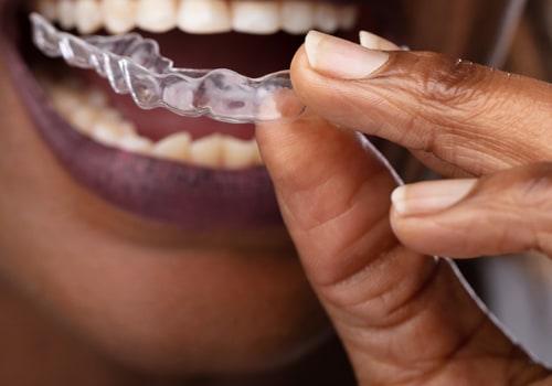 The Secret To Straighter Smiles: Invisalign Clear Braces In San Antonio