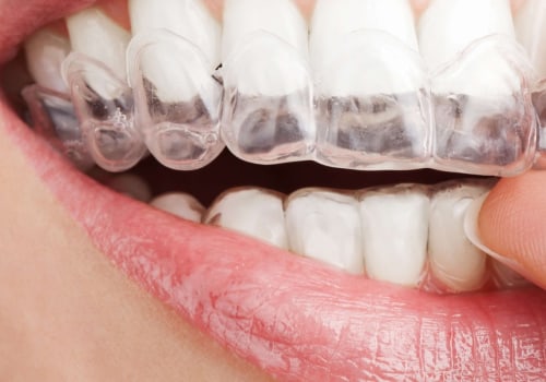 Transform Your Smile With Invisalign Clear Braces: A Dentist In Manassas Park, VA, Offers The Best Solution