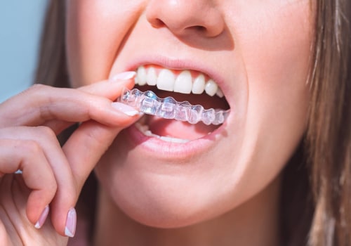 Relieving Discomfort from Invisalign Clear Braces with Dental Wax