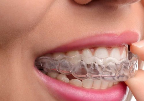 Can I Eat and Drink with Invisalign Clear Braces?