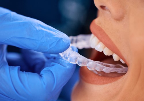 Why Refinement Stages Are More Common Than Many Invisalign Patients Expect