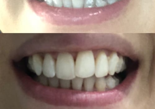 Why Some Invisalign Cases Require More Refinement Stages Than Expected