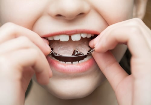 Clear Braces Without The Hassle: Invisalign For Children's Dentistry In Mcgregor, TX