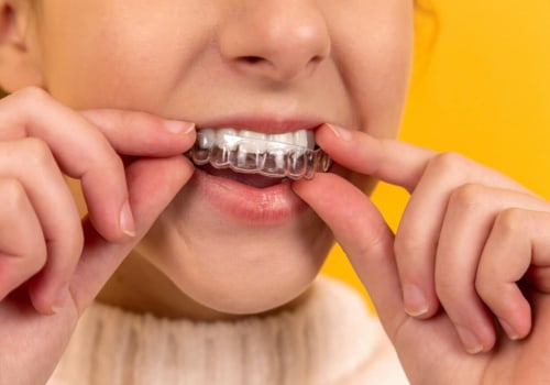 Why Invisalign Clear Braces Are A Popular Choice Among Sydney Residents