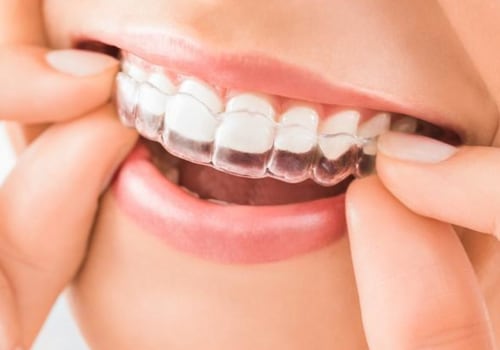 Straighten Your Teeth With Invisalign Clear Braces In Austin