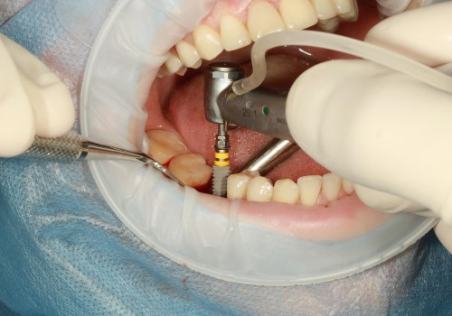 Invisalign and Dental Implant Surgery: A Guide for Patients