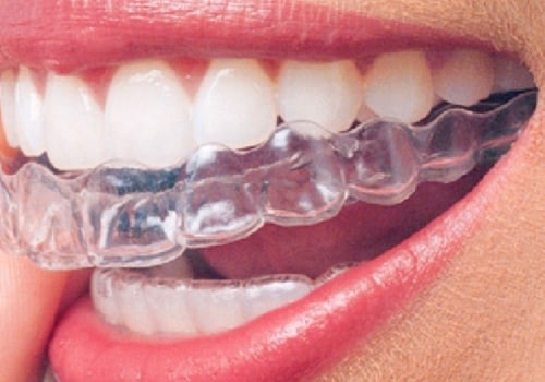 Why Spring, TX Adults Are Choosing Invisalign Clear Braces For A Confident Smile