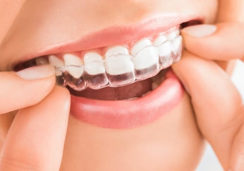 How Long Does It Take to Straighten Teeth with Invisalign Clear Braces?