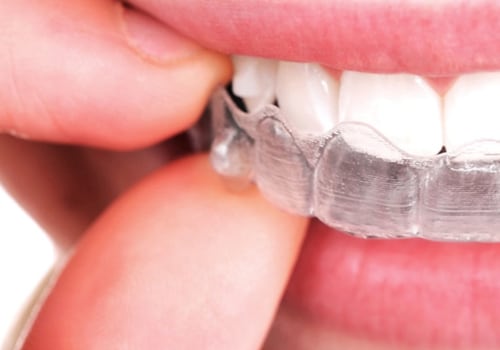 Caring for Your Invisalign Clear Braces: A Guide