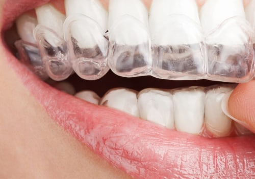 How Long Does It Take to Get Invisalign Clear Braces Removed?