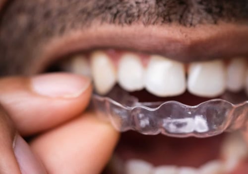 Maintaining Your Smile After Invisalign Clear Braces