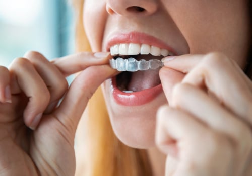 How Invisalign Clear Braces Can Improve Your Oral Health In Cedar Park, TX