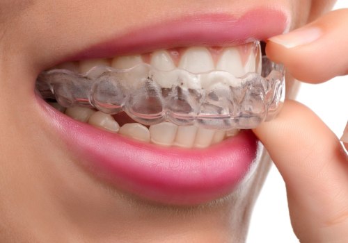 Can I Use Over-the-Counter Pain Relievers for Invisalign Clear Braces?