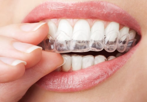 Do I Need to Visit the Dentist Regularly While Wearing Invisalign Clear Braces?