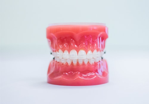 Invisible Transformation: Discovering The Magic Of Invisalign Clear Braces In Monroe